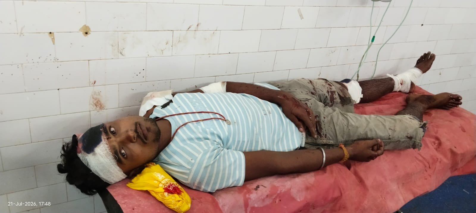 साहिबगंज में सड़क हादसा: गड्ढे में बाइक अनियंत्रित होने से युवक घायल, सदर अस्पताल में भर्ती
